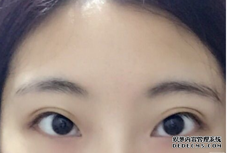 什么是間歇性外斜視，需要保健嗎